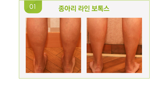 종아리 라인 보톡스 시술 전후 사진.