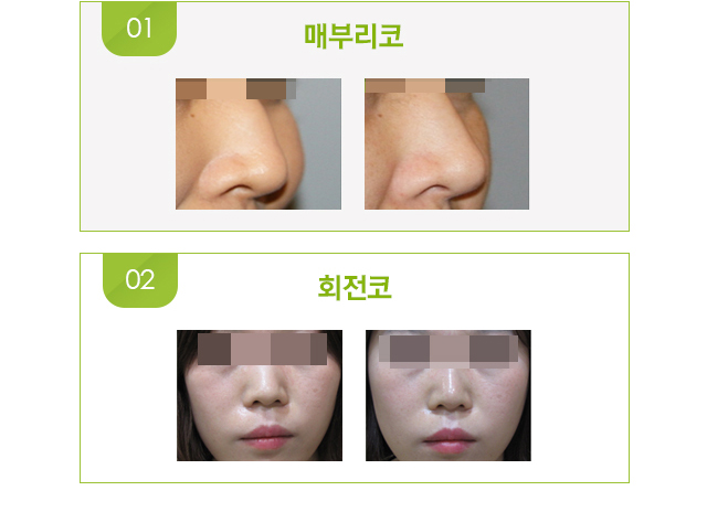 매부리코, 회전코 시술 전후 사진.