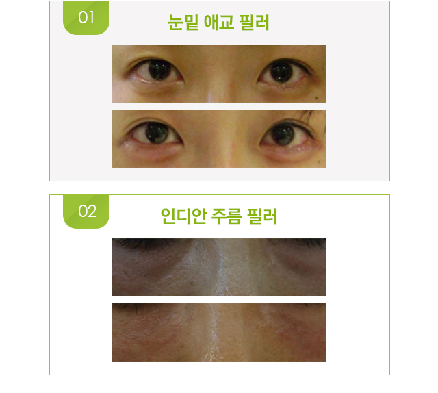 눈밑 애교 필러, 인디안 주름 필러 시술 전후 사진.