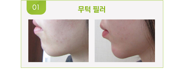 무턱필러 시술 전후 사진.