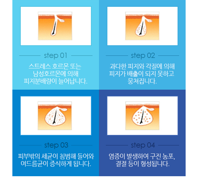 step01.스트레스 호르몬 또는 남성호르몬에 의해 피지분배량이 늘어납니다. Step02. 과다한 피지와 각질에 의해 피지가 배출이 되지 못하고 뭉쳐집니다. step03. 피부밖의 세균이 침범해 들어와 여드름균이 증식하게 됩니다. step04.염증이 발생하여 구진 농포, 결절 등이 형성됩니다.