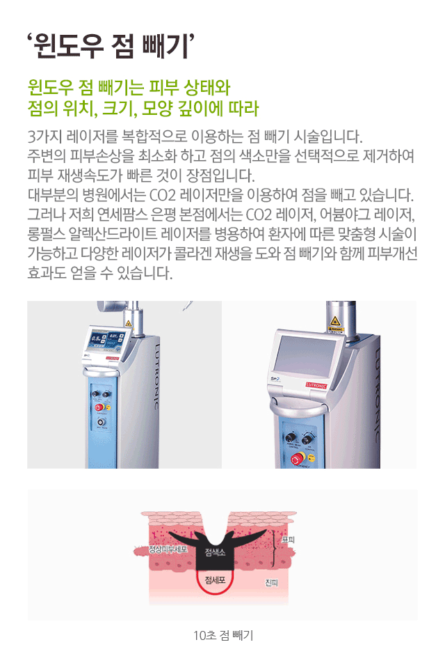 윈도우 점 빼기. 윈도우 점 빼기는 피부 상태와 점의 위치 크기, 모양 깊이에 따라. 3가지 레이저를 복합적으로 이용하는 점 빼기 시술입니다. 주변의 피부 손상을 최소화 하고 점의 색소만을 선택적으로 제거하여 피부 재생속도가 빠른 것이 장점입니다. 대부분의 병원에서는 CO2 레이저만을 이용하여 점을 빼고 있습니다. 그러나 저희 연세팜스 은평 본점에서는 CO2레이저, 어븀야그 레이저, 롱펄스 알렉산드라이트 레이저를 병용하여 환자에 따른 맞춤형 시술이 가능하고 다양한 레이저가 콜라겐 재생을 도와 점 빼기와 함께 피부개선 효과도 얻을 수 있습니다. 10초 점빼기.