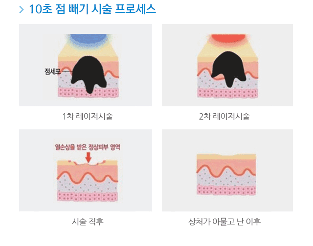 10초 점 빼기 시술 프로세스.