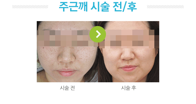 주근깨 시술전후 사진.