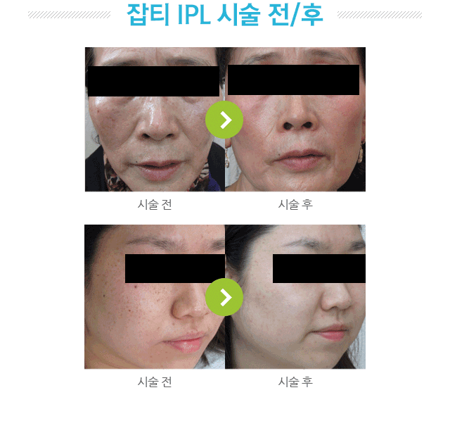 잡티 IPL시술 전후 사진.