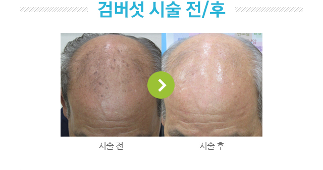 검버섯 시술 전후 사진