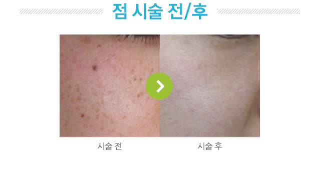 점 시술 전후 사진