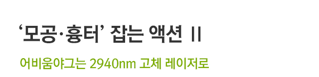 모공·흉터 잡는 액션2 어비움 야그. 어비움야그는 2940nm 고체 레이저로