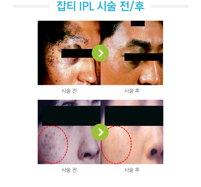 잡티 IPL 시술 전후 사진