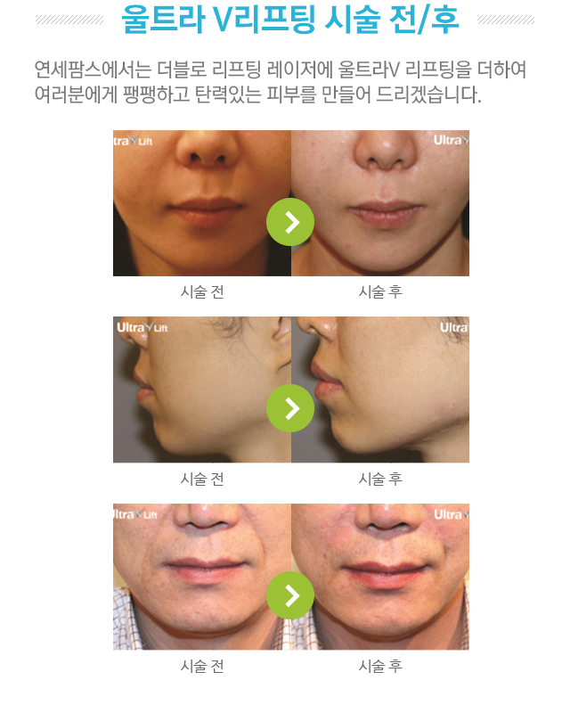 울트라V리프팅 시술 전/후 사진. 연세팜스에서는 더블로 리프팅 레이저에 울트라V리프팅을 더하여 여러분에게 팽팽하고 탄력있는 피부를 만들어드리겠습니다.