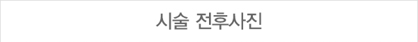 시술 전후 사진